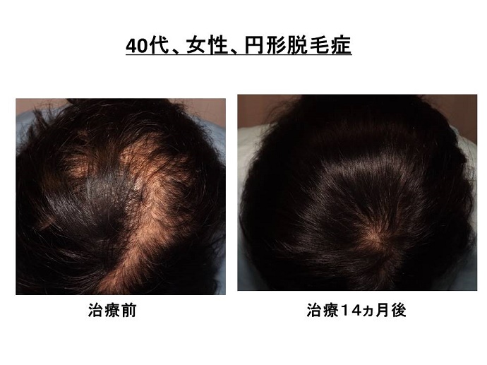円形脱毛症　病院